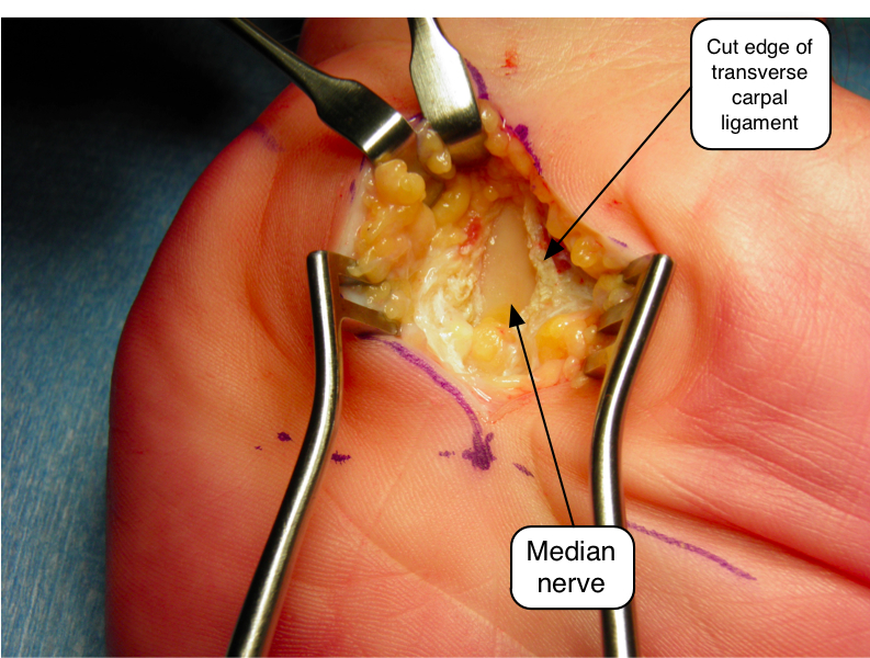 Choosing the Right Specialist for Carpal Tunnel Surgery NZ